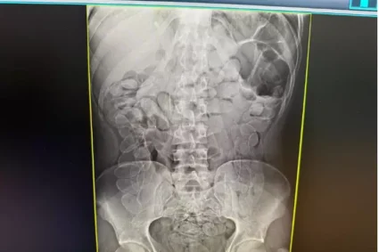 Flagrada com 90 Cápsulas de Cocaína no Corpo: Boliviana é Presa Após Cirurgia em Corumbá