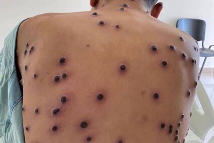 Corumbá Emite Alerta Oficial sobre MPOX e Reforça Monitoramento Após Nova Cepa Ser Identificada no Exterior