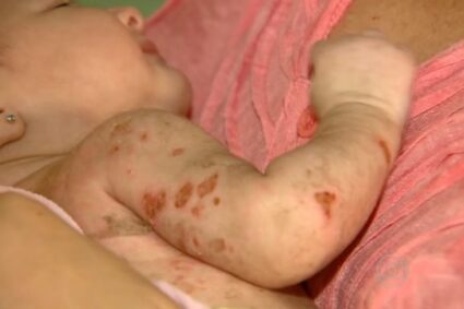 Alerta Máximo: Corumbá confirma primeira morte por chikungunya; veja os bairros sob risco e como se proteger